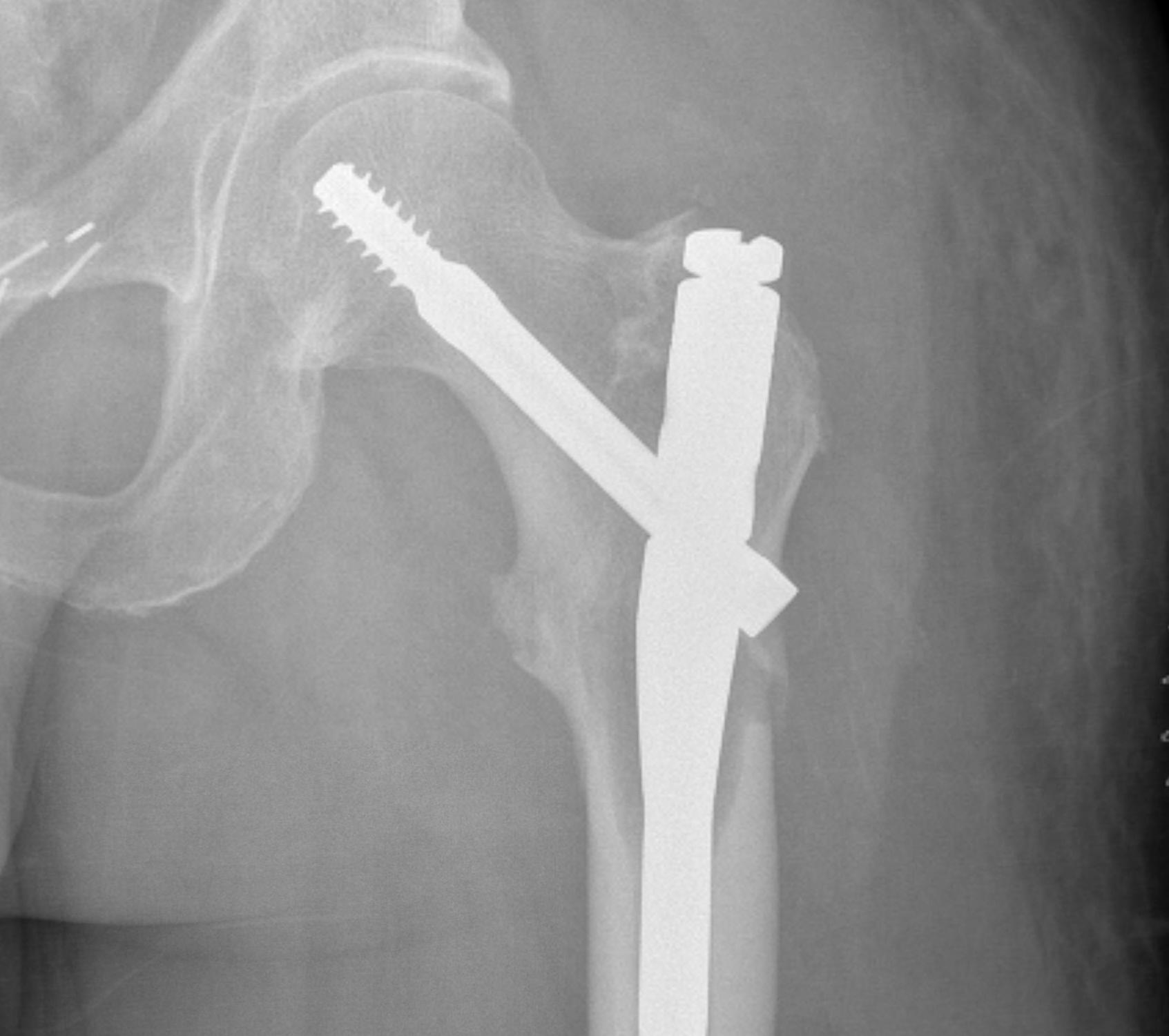 Subtrochanteric Metastasis and Nail0002